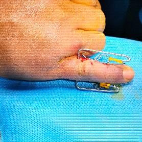 Dynamic external fixator for phalanx fracture4